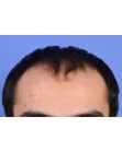 Before Hair Transplant&nbsp;Front